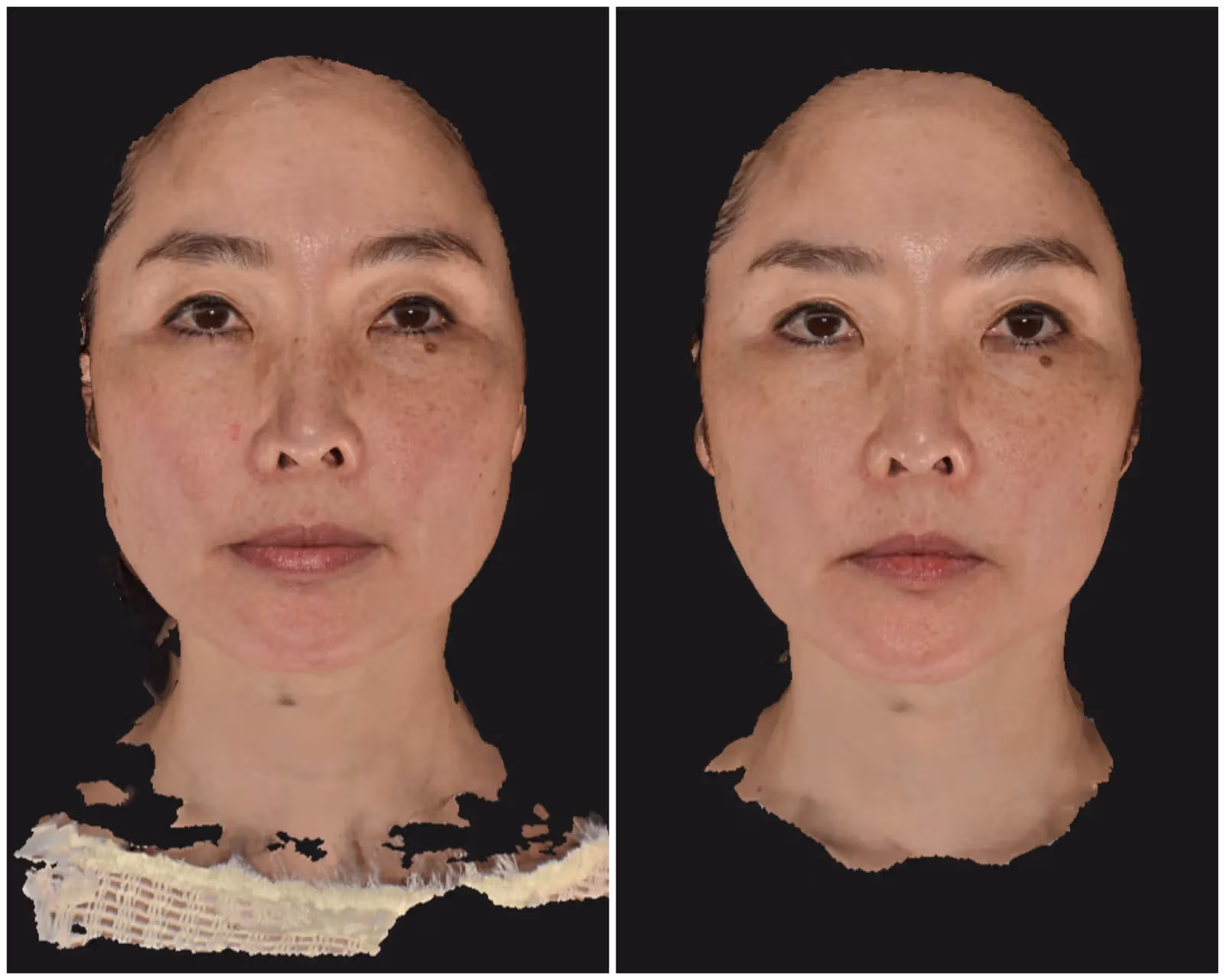 シワは、消しすぎないが新常識。脱“ボトックス顔”を叶えるには？